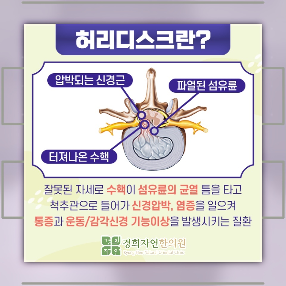 젊은 세대 허리디스크, 갑작스러운 자세 변화가 영향을 줄 수 있어