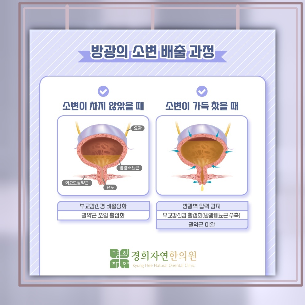 기침과 웃음 뒤 소변이 새는 복압성 요실금 살펴보기